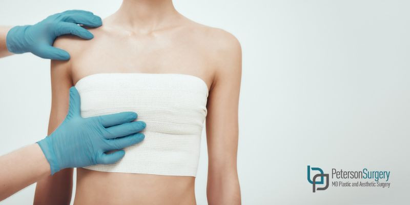 Navigating Breast Mastopexy: What You Need to Know Before Surgery